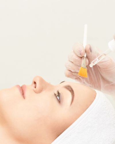 Chemical Peel